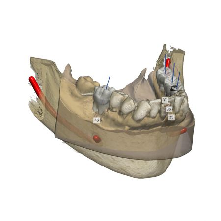 Implant Planner Stand Alone license