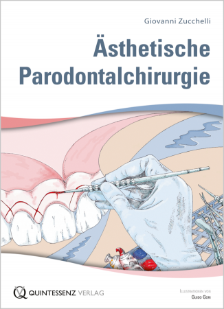 Aesthetische Parodontalchirugue,Zuccheli