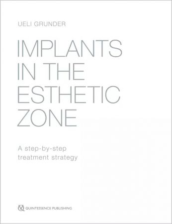 Implants in the Esthetic Zone - Leseprobe