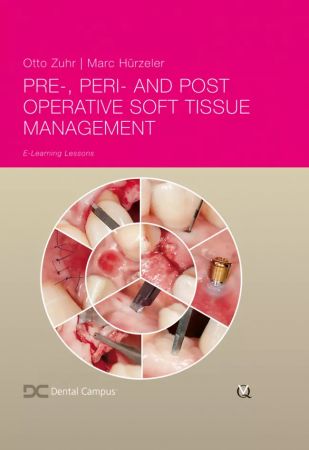Pre-, Peri- and Post-Operative Soft Tissue Management - Otto Zuhr / Markus B. Hürzeler