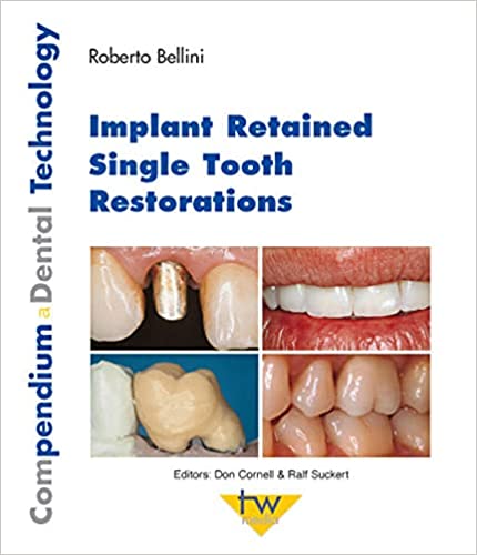 Implant Retained Single Tooth Restorations
