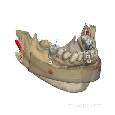 Implant Studio Stand Alone license